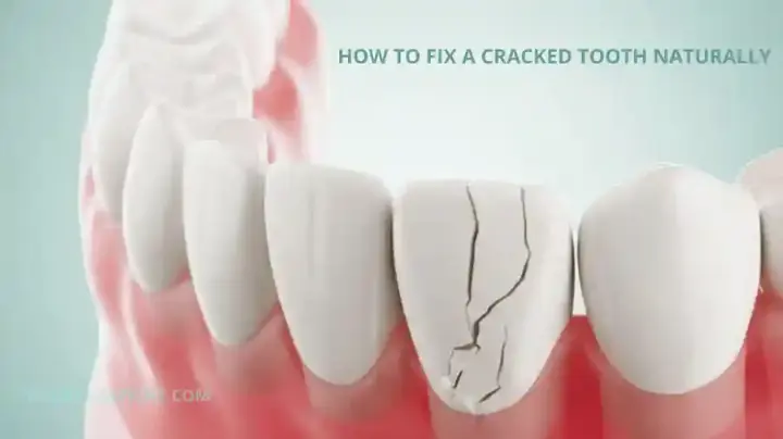 How to Fix a Cracked Tooth Naturally: